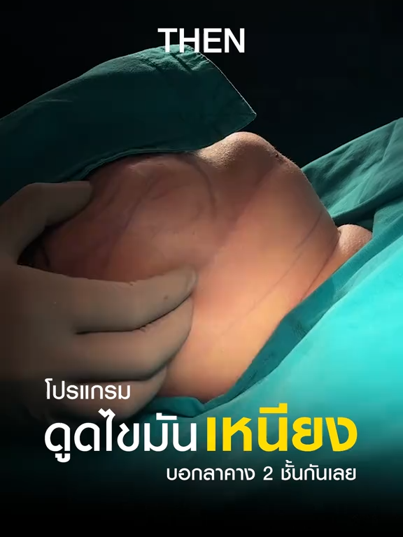 โปรแกรมดูดไขมันเหนียง บอกลาคาง 2 ชั้น สนใจดูดไขมันกับ #หมอกายmasterpiece Inbox เลย . ปรึกษาปัญหาลดสัดส่วนฟรี ไม่มีค่าใช้จ่าย ด่วนนะ ก่อนคิวเต็ม!! . #masterpiecehospital #ดูดไขมัน #Liposuction #ลดสัดส่วน