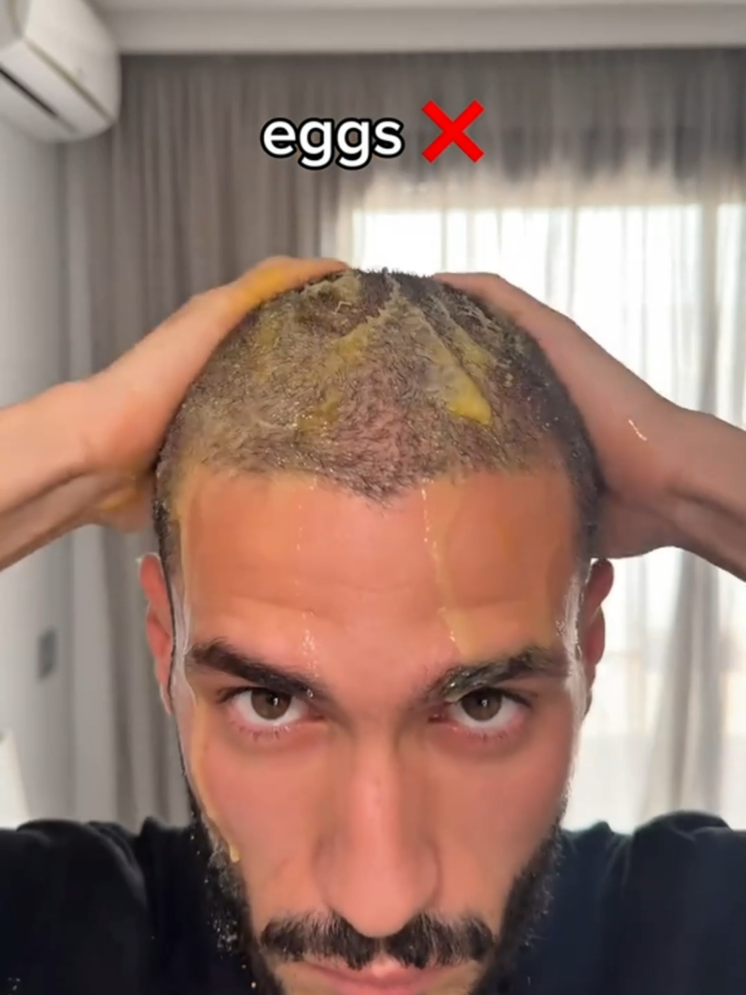 🔥 Stop Hair Loss – Regrow Naturally! ✅ No more bald spots after just 1 treatment 💪 Strengthen roots, thicken hair, and restore shine 🌿 100% natural – no side effects 🎁 30% OFF for first 100 customers! 📩 Message now – grow your hair back today! #hairloss #baldness #hairfall #HairGrowth