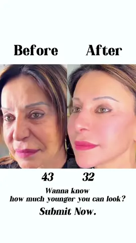 收紧提升：面部皮肤下垂.通过筋膜提升科技重塑面部轮廓.恢复紧绷感你的整容.温和有效！ #facelift #beauty #skincare #GlowUp 