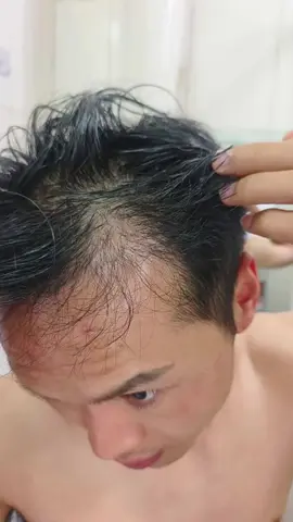 Tuấn đến với phòng khám với tình trạng rụng tóc phần M khá sâu. Trải qua phác đồ điều trị phù hợp của Thanh đã nhận được kết quả như mong đợi. Chúc mừng em nhé ✅ #baáidalieutranthanh #xuhuong #viral #fyp 