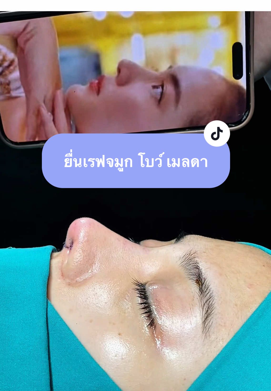 “หมอคะ หนูขอเป็นพี่ #โบว์เมลดา คนที่สองของประเทศไทยเลยนะคะ” 💓🥰 @🐾AAmpere🐾 น้องแอมแปร์ขอมา หมอกิ๊ฟnsc จัดให้เลยค่า #แอมแปร์แก้จมูก #อิ่มแป้คือแอมแปร์ #แก้จมูกnsc #nscclinic 