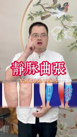 静脉曲张 varicose veins #静脉曲张 #varicoseveins #中医 #fyp #tcm #穴位 
