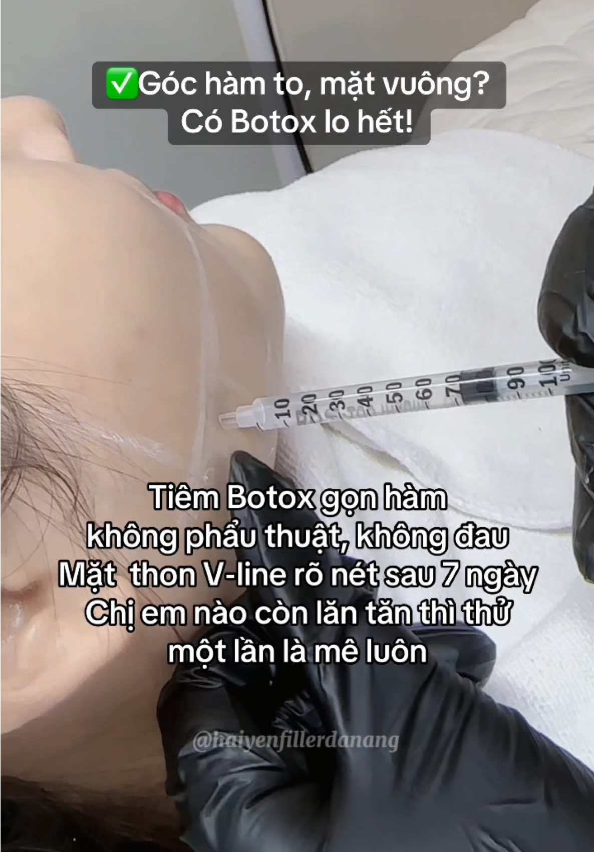 Không cần giảm cân, chỉ cần tiêm đúng điểm – là mặt đã V-line ngay ✨ #thongonham  #botox #43danang  #tiembotox  #xuhuong  