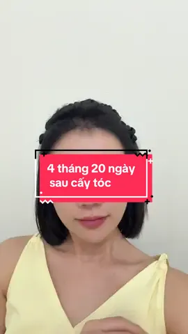 4 tháng 20 ngày sau cấy tóc #caytoctuthan #trán_cao #rụng_tóc #rụng_tóc 