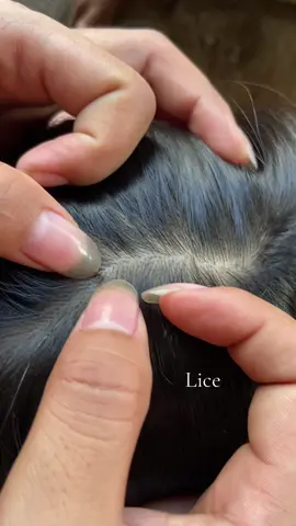 😱😱#omg #lice #liceremoval 