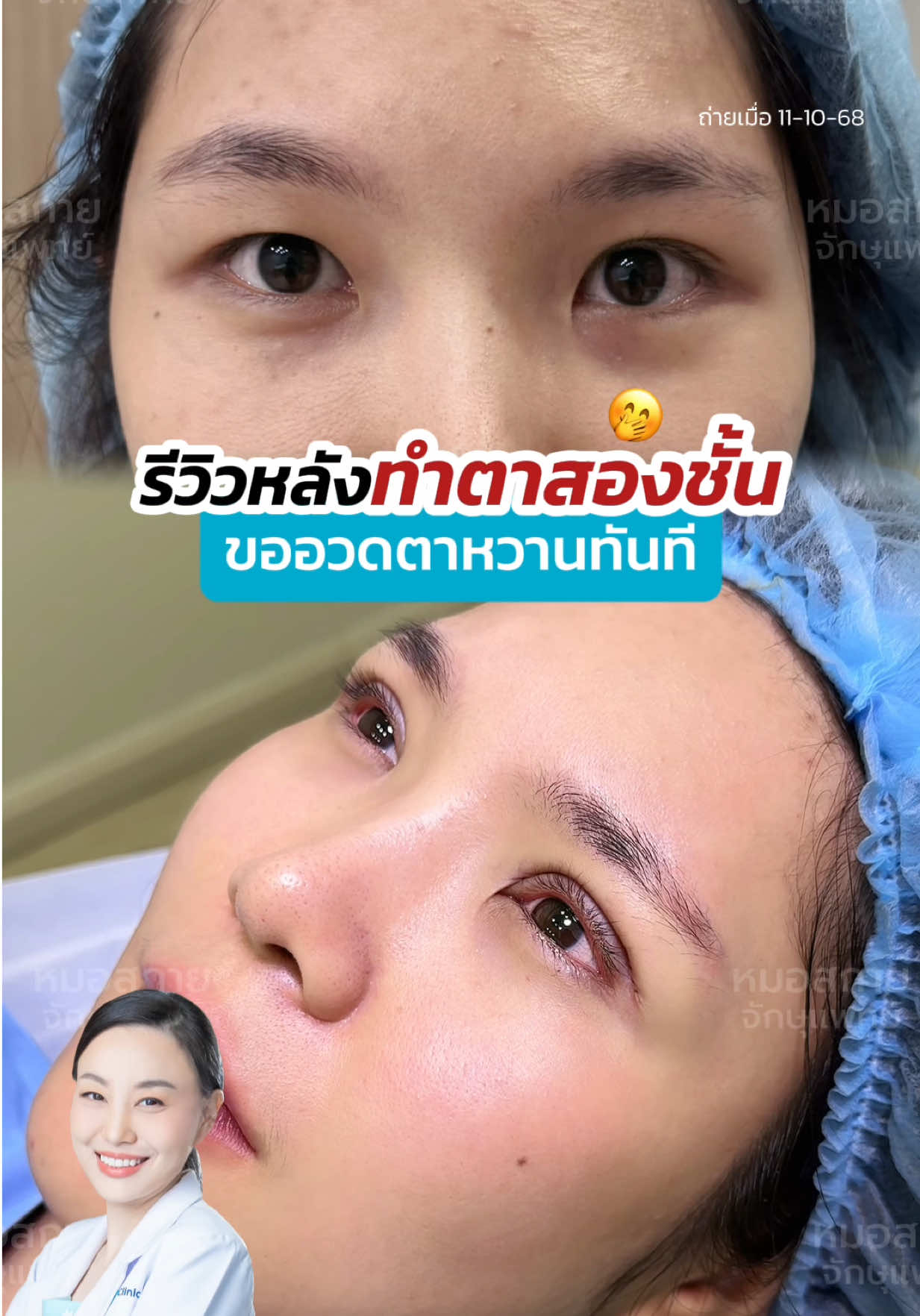 รีวิวหลัง #ทำตาสองชั้น💖 ขออวดตาหวานทันที‼✨ #ไม่มีชั้นตา  #หมอสกาย #จักษุแพทย์ #สกายคลินิก