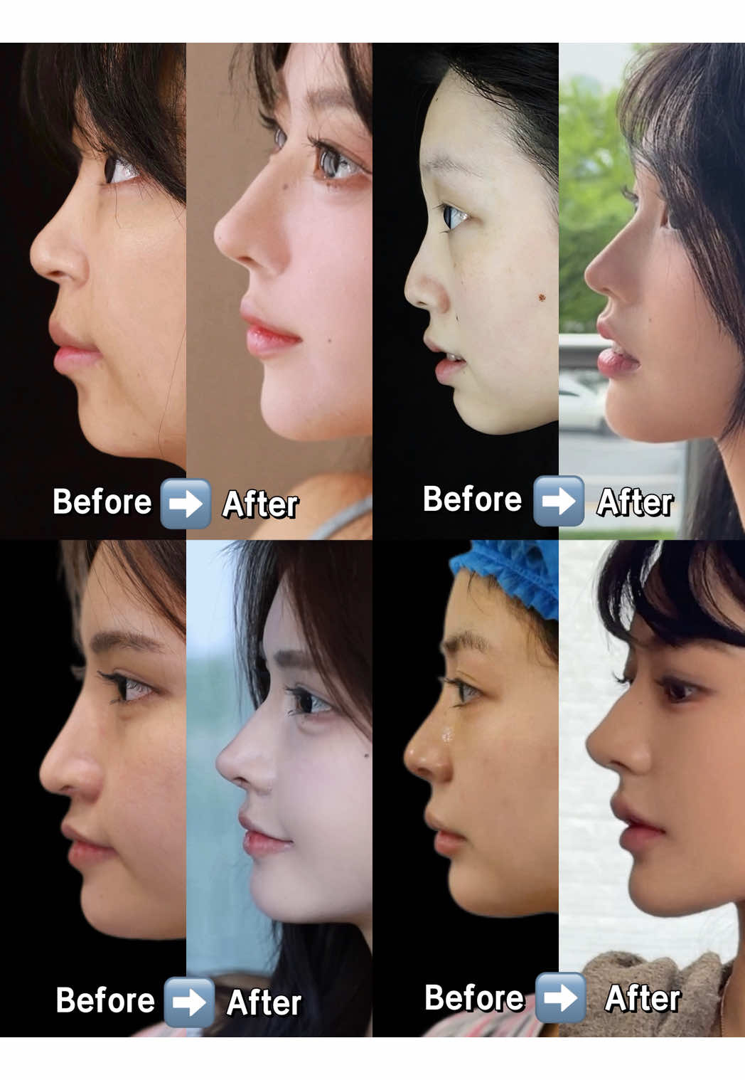 Before and after rhinoplasty photos - transforming your nose to enhance your beauty. #nosejob #rhinoplasty #鼻子 #鼻综合 #nose 