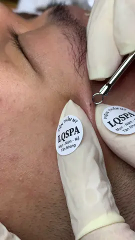 Nhỏ#chamsocdamun#chamsocdaseo#chamsocdanam#tanbinh#Lqspa&academy