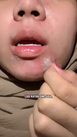 bisa di pake ke sekolah #focalskin #focalskinid #acnecure #acnepatch