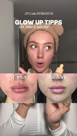 Anzeige| Koreanische Skincare ist einfach anders🥹✨ Mit meinem Code „INF10LISSYB“ könnt ihr bei @Stylevana nochmal extra sparen🫶 Ihr müsst euch vorher nur registrieren!#pickeltipps #koreanischehautpflege #koreanskincare #pickelmale #akne 