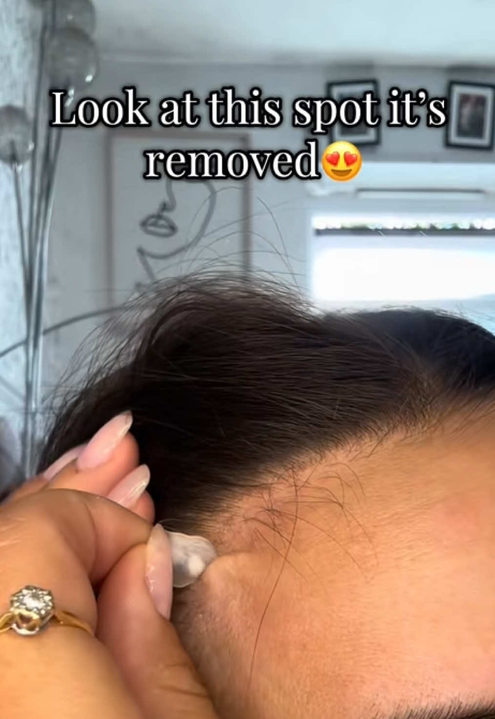 😍🤢 @PurePatch  #pimple #tiktokshop #blackhead #tiktokmademebuyit #viral 