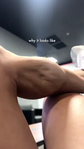 Have you ever seen a cramp like this before? 😩  @NOCCO USA electrolyte to the rescue ❤️‍🩹 This is the importance of electrolytes. 