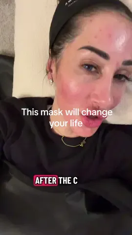 Not sponsored just #obsessed #skin @CO2LIFT 