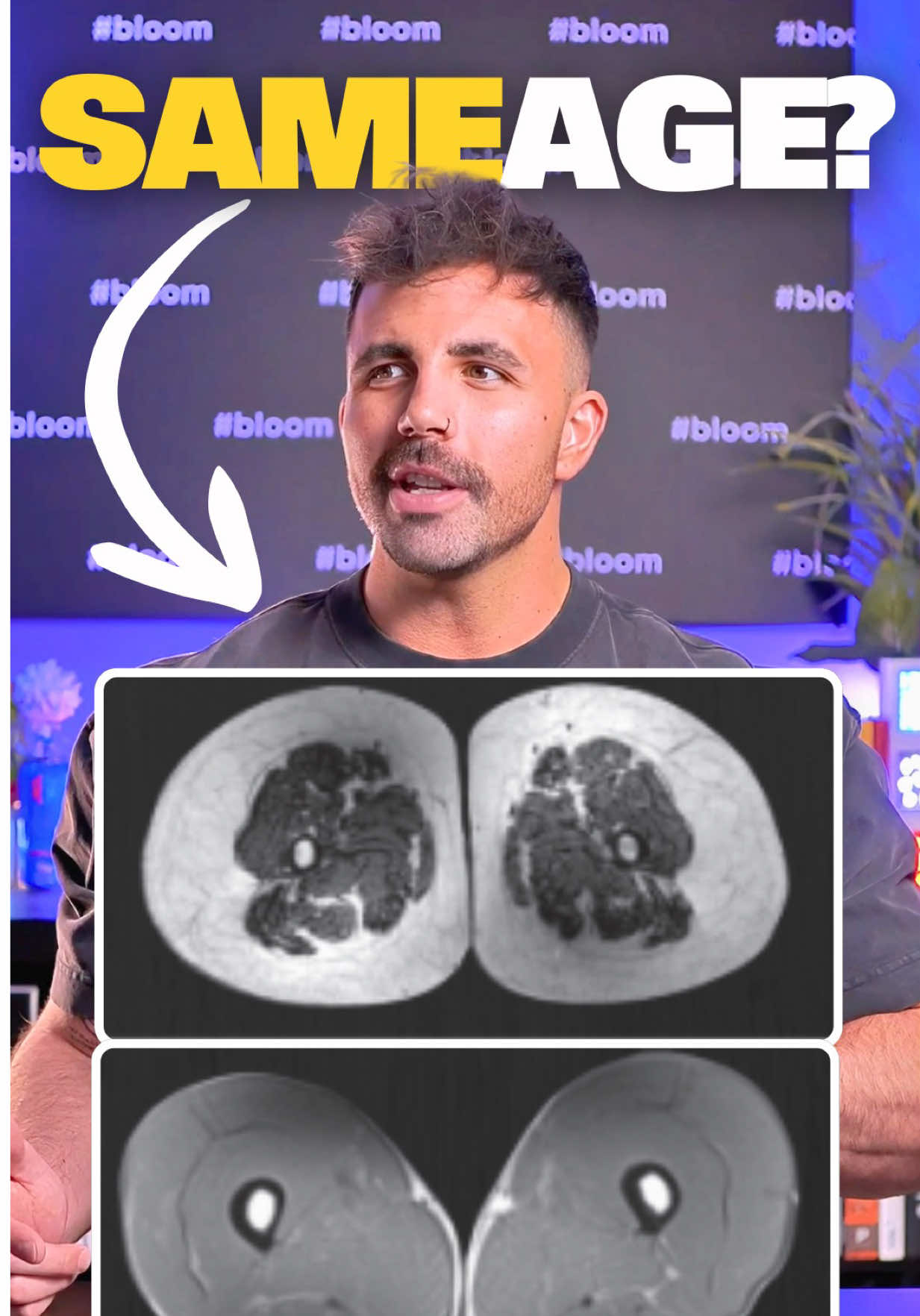 Fun Fact: One of the top reasons people get checked into assisted living is because they can’t get off the toilet by themselves Or in other words: They don’t have the lower body strength and mobility to do one half rep of a body weight squat to stand up off the toilet by themselves I’m not saying assisted living is the only metric that matters... But it’s a pretty good reflection of someone’s quality of life If two people both live to 80 years old And one spends their last 10 years in assisted living, while the other is out exploring the world not limited by their body, that’s two completely different lifetimes You can’t stop aging, but you can decide what it looks like So if you don’t work out because aesthetics aren’t important to you, that’s cool But at least do it for this Original study: PMID: 22030953 DOI: 10.3810/psm.2011.09.1933 #FitTok #GymTok #gym #Fitness #samsulek 