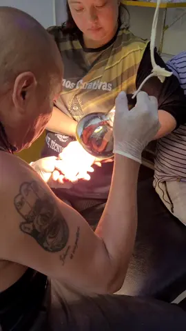 Paciente masculino de 83 años con antecedente de caída hace más de un año, que le provocó una luxación completa de la falange media sobre la proximal. Durante la valoración se evidenció que la articulación se encuentra consolidada con formación ósea importante, lo que impide su reducción manual. Se informó al paciente que la única alternativa para corregir la deformidad sería un procedimiento quirúrgico,sin embargo, debido a su avanzada edad, condición diabética y ausencia de dolor o limitación funcional significativa, se recomienda manejo conservador sin intervención quirúrgica. 