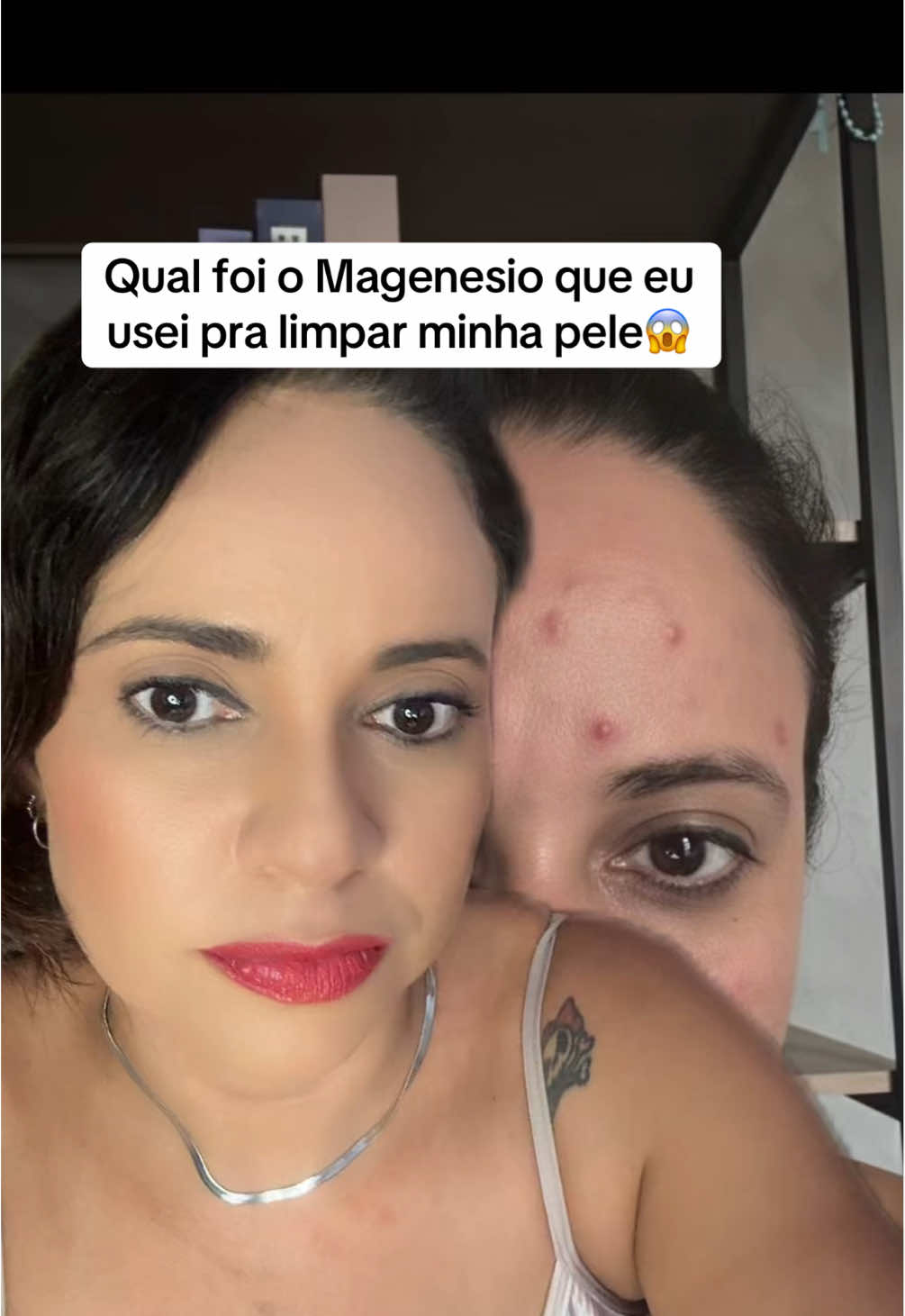 Pele feia minha filha?? Tá com falta deste nutriente aqui 😱 #magnesio #pele #acne 