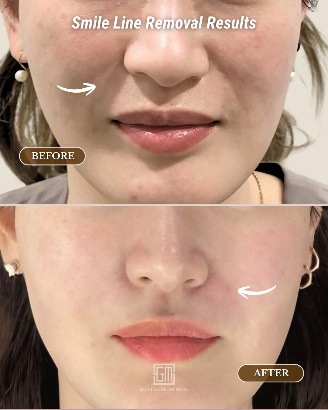 Before ➡️ After: Smile lines gone — collagen restored 💎 This is the PLLA Booster, one of Korea’s most loved anti-aging treatments that naturally restores volume and smooths wrinkles from within. Unlike filler that simply adds volume, PLLA (poly-L-lactic acid) works by stimulating your body’s own collagen — giving natural, long-lasting results that improve over time. ✨ Targets: Smile lines, cheek volume, temples & neck lines ✨ Results: Restored firmness, smooth texture, lifted look ✨ Downtime: Slight swelling for 2–7 days — then collagen does the rest 👏 The secret to looking younger without looking overfilled. 📍 Patients from all over the world trust SGM to connect them with Korea’s top-certified doctors, full English support, and VIP aftercare. 🇰🇷 📩 DM us on WhatsApp/KakaoTalk or tap the link in bio for your FREE online consultation 📞 Tel: +82-10-5920-5546 (English) 🌐 seoulguidemedical.com For a free ONLINE consultation:  https://tinyurl.com/SGM2025consult Website: https://seoulguidemedical.com Social Media: https://facebook.com/seoulguidemedical https://instagram.com/seoulguidemedical https://www.tiktok.com/@seoulguidemedical https://youtube.com/seoulguidemedical #SeoulGuideMedical #fyp #KoreanSkinClinic #SmileLineTreatment #AntiAgingKorea