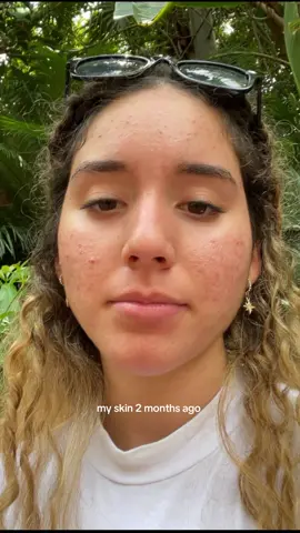 #acne #acnetreatment 