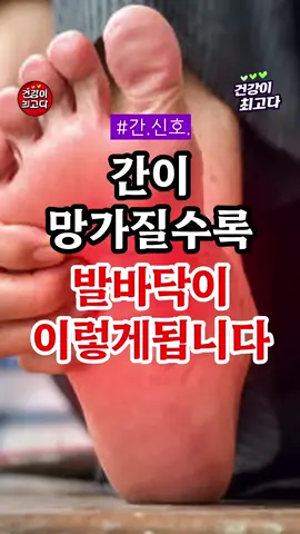 간이 망가질수록 발바닥이 이렇게 됩니다 #건강 #건강정보 