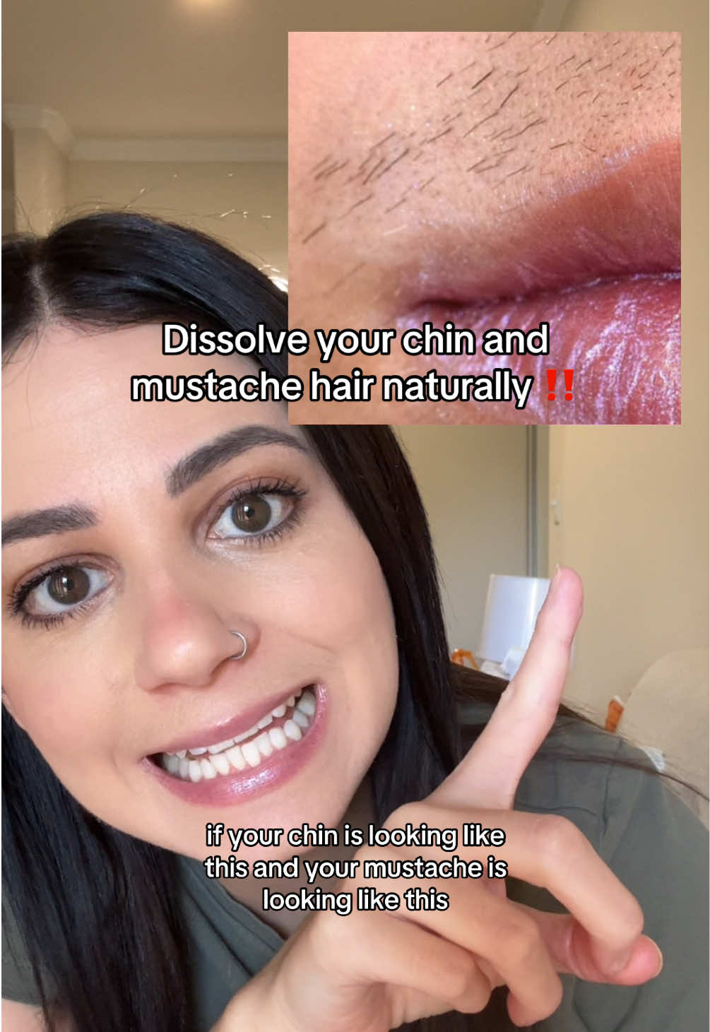 Why did I just now learn about Cyperus rotundus oil!? I have never felt smoother and hairless 🥺 #cyperusrotundusoil #pcos #facialhair #chinhair 