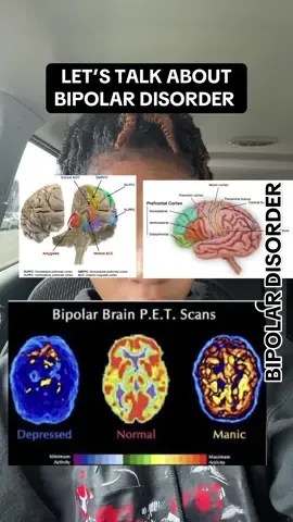 Bipolar disorder is more than emotions, it’s how the brain regulates energy and mood. #bipolardisorder #bipolar #bipolarawareness #fyppppppppppppppppppppppp 