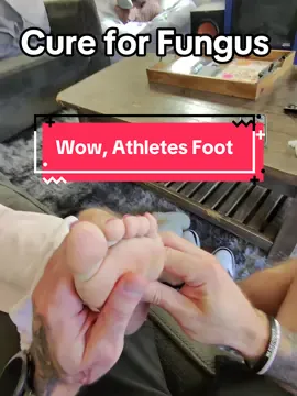 Cure for Toe Fungus #lunavia #antifungal #athletesfoot #tiktokshopblackfriday #tiktokshopcybermonday 