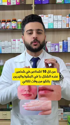 شخص من كل 10 اشخاص عنده المشكله دي في ايده او بشرتة بسبب جفاف الجلد الشديد  #مرطبات_بشرة #إكزيما #ترطيب #eczema 