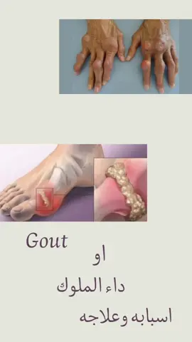 مرض النقرس #نقرس #داءالنقرص