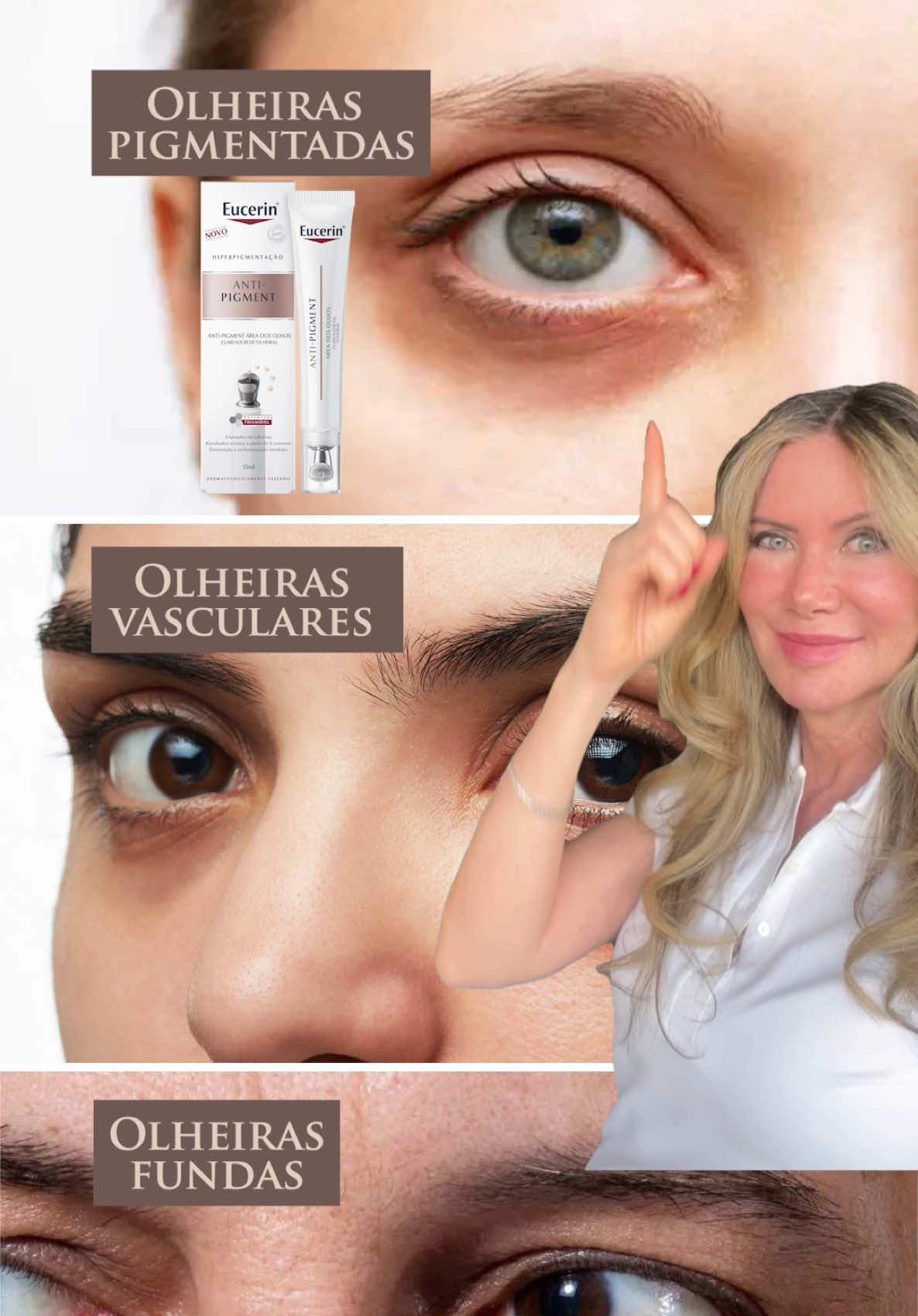 Se você tem... ⚜️Olheiras pigmentadas – Eucerin Anti-Pigment contém Thiamidol, um ativo que inibe a produção de melanina, ajudando a clarear gradualmente as áreas escurecidas da pele, incluindo olheiras causadas por pigmentação. ⚜️ Olheiras vasculares – Pigmentclar Olhos (La Roche-Posay) possui cafeína e phe-resorcinol, que estimulam a microcirculação e reduzem a coloração azulada ou arroxeada das olheiras vasculares, além de iluminar o olhar. ⚜️Olheiras fundas – O ácido hialurônico repõe o volume perdido na região da pálpebra inferior, suavizando o “sulco” da olheira e melhorando a aparência de cansaço. ⚜️ Poros abertos – Medicube Zero Pore One Day Cream é rico em extratos adstringentes e niacinamida, ajuda a controlar a oleosidade e contrair visualmente os poros, além de melhorar a textura da pele com o uso contínuo. ⚜️Cravos abertos – Cleanance Comedomed (Avène), formulado com Comedoclastin™️, derivado do cardo-mariano, que regula a produção de sebo e impede a formação de novos comedões abertos, além de reduzir os existentes. ⚜️ Cravos fechados – Purified Skin (Neutrogena), combina ativos que ajudam a desobstruir os poros e prevenir a formação de cravos fechados, controlando a oleosidade sem ressecar. ⚜️Melasma – Mela B3 (La Roche-Posay), contém niacinamida e Melasy™️, que reduzem a inflamação e a produção excessiva de melanina, clareando o melasma e uniformizando o tom da pele. ⚜️Manchas de acne escuras – Ac. Mandélico [e um alfa-hidroxiácido de ação suave, com propriedades clareadoras e antibacterianas, ideal para tratar hiperpigmentação pós-inflamatória sem irritar peles sensíveis. ⚜️Manchas de acne avermelhadas – Clarité Sérum Clareador TX (Dermage), formulado com Arbutin, Ac. Tranexâmico, Gluconolactona e Niacinamida, que reduz a inflamação residual da acne e acelera a uniformização do tom da pele. Você já testou algum desses produtos? O que achou?  ***Todos os produtos mencionados são apresentados de forma imparcial e independente; não é publicidade. Porque é o dermatologista quem primeiramente pode falar sobre produtos para pele.*** #cuidadoscomapele #olheiras #manchasnapele #skincare #dermatologia  