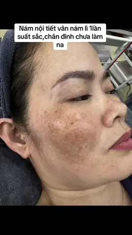 Ce chuyên nám nhìn là bit nám khó luôn na.nám dây mạch máu,nội tiết,lì,chân đinh lại trên nền da yếu😝.mà 1lần enzym đỉnh cỡ này,chân địn thì chưa thể het dk na.nh mảng lì thì đã sx chưa ạ.Ce cần phác đồ ib P chia sẻ na#nám #mụn #maketing #kinhdoanhspa 