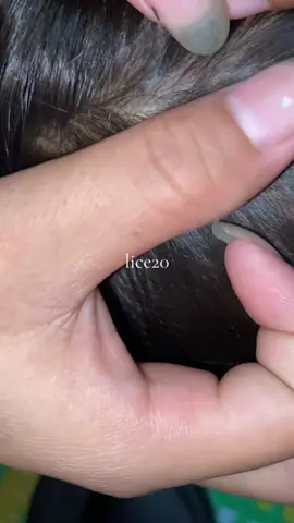 😱😱😱#liceremoval #omg #lice 