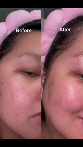 AfterLab Mild Acidic Azulene Cleanser pH5.5 and AfterLab Azulene Cica Calming Cream @afterlab_global @BAZZAAL are great for sensitive skin. It doesn’t irritate my skin and it gives my skin a glass skin effects.  AfterLab products are now available for purchase on AMAZON #afterlab #kbeautyskincare #koreanskincare #sensitiveskin #azulene 