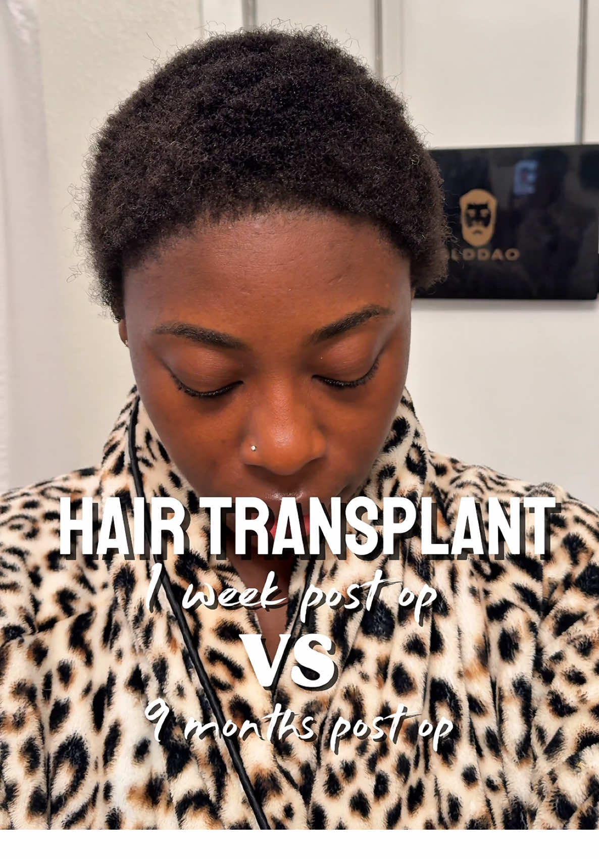 Trust the process 😌 @Heva #hairtransplant #hevaclinic #hairtransplantturkey #hairtransplantsurgery 