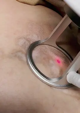 💡 Công dụng của CO2 Fractional trong trị sẹo 	•	🔹 Tác động sâu vào lớp trung bì da, tạo các vi điểm nhỏ li ti giúp kích thích tái tạo collagen và elastin. 	•	🔹 Phá vỡ mô sẹo cũ, làm da mịn màng, đều màu hơn. 	•	🔹 Làm sáng vùng da thâm, giúp da đều màu, săn chắc. 	•	🔹 Phù hợp cho các loại sẹo: 	•	Sẹo rỗ, sẹo lõm sau mụn 	•	Sẹo thâm, sẹo cũ lâu năm 	•	Sẹo lồi nhỏ (kết hợp thêm thuốc đặc trị) #PhamMyNgoc #dalat #LaserCO2 #Fractional 