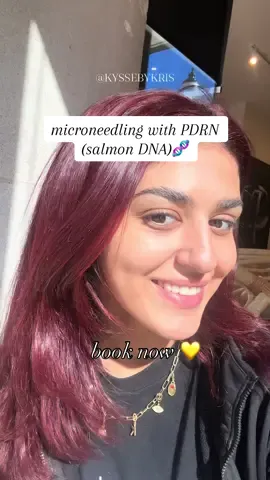 A peek behind the scenes of my microneedling with PDRN treatment ✨ One of my favorite ways to rejuvenate skin, improve tone + texture, and enhance glow over time. #aestheticpa #botox #filler #microneedling #redbanknj @Evolve Med Spa 