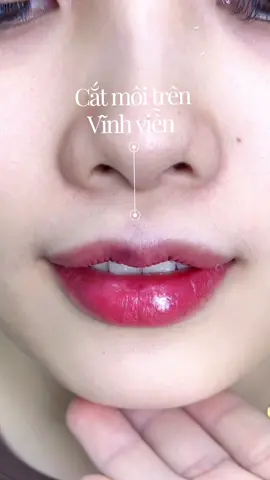 •Cắt môi chuẩn tỉ lệ vàng – Môi đẹp, nét sang, yêu ngay từ ánh nhìn đầu tiên 💋 #lamdepuytin #catmoi #catmoidep 