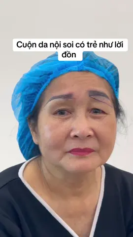 Cuộn da nội soi - Phương pháp dành cho tất cả các khách hàng bị sụp mí do da dư ở phần mắt trên . Ib cho mình để được tư vấn nhé ❤️