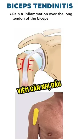 Viêm gân nhị đầu là 1 trong các nguyên nhân gây đau vai phổ biến #viemgan #viemgannhidau #rachganchopxoay #dauvai #khamkhopvai @Bs Tân thích khám khớp Vai 