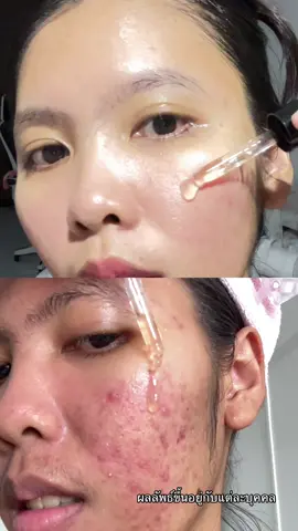 ลดรอยสิวที่ใช้ตอนเป็นสิว #เมเบลมารีวิว #ลดรอยดํารอยแดงจากสิว #เซรั่มลดรอย #เซรั่มมานูก้า 