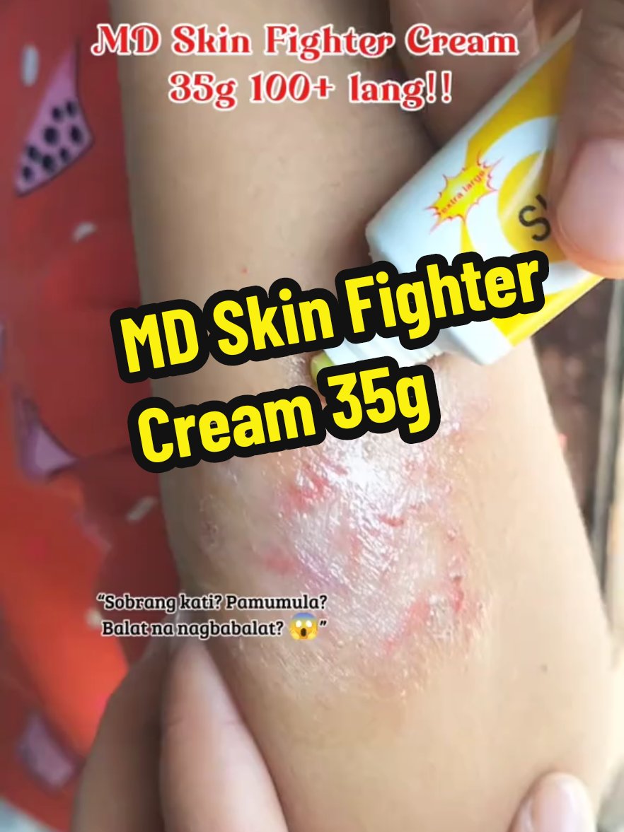 “Ang kati at pamumula, kalaban ‘yan ng confidence 😩 Pero ngayon… may kakampi ka na! 💪 Subukan mo ang MD Skin Fighter Cream — mabilis, walang lagkit, at effective talaga! 🔥 #SkinFighter #MDcream #ByeKatiHelloConfidence  #MDSkinFighter #AntiKatiCream 