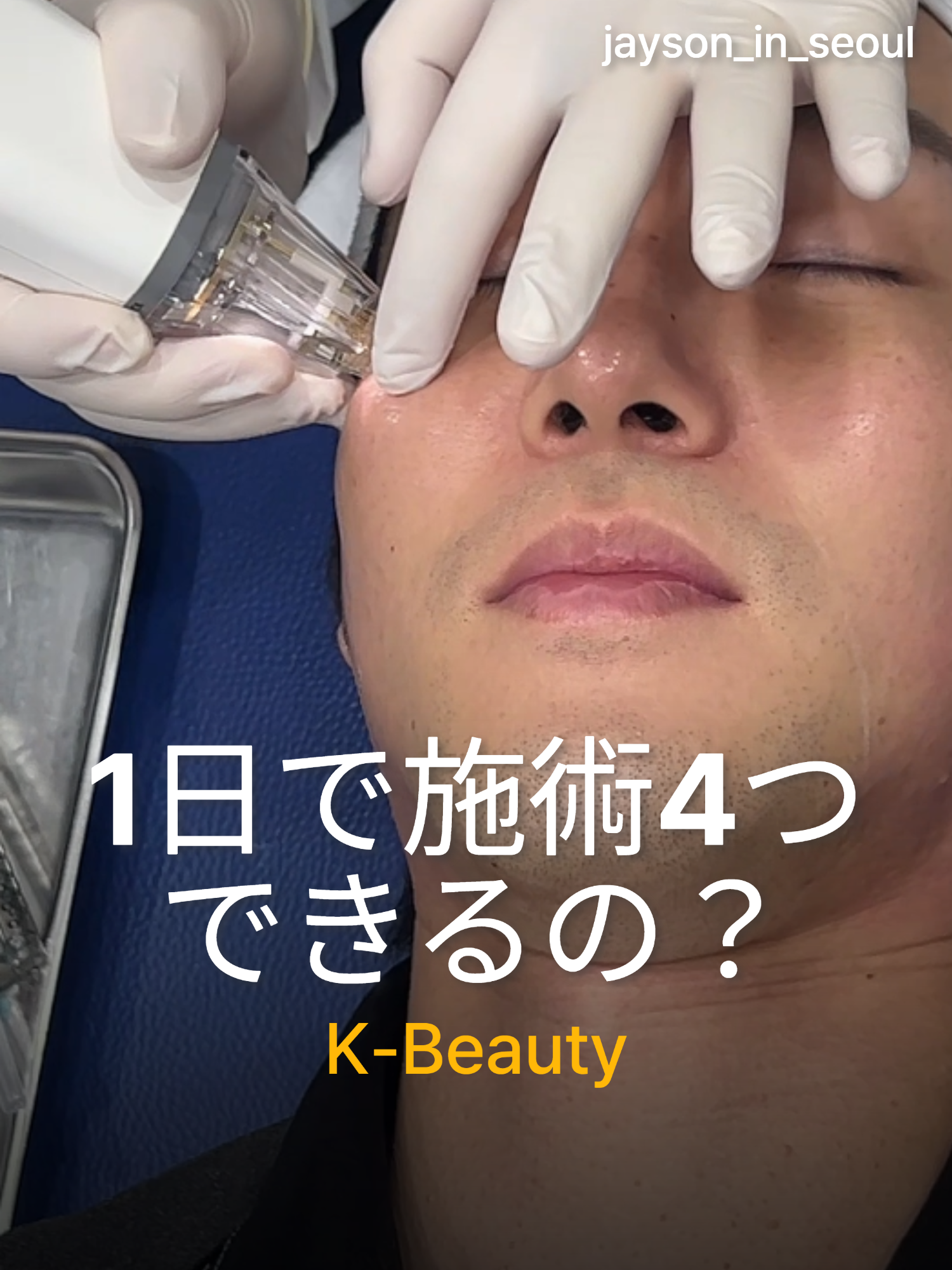 韓国のスキンケアを試してみて、本当に効果があるかどうか試してみました！ 今回はたった1日で4種類の治療を受け、今ではその経験を共有しています. プロセスについて気になったり、私がどんな治療を受けたのか知りたければ、コメントを残すかDMを送ってください! #韓国皮膚科 #肌管理 #美肌 #美容クリニック #韓国旅行 #韓国コスメ #垢抜け #おすすめにのりたい #コスメ #ツヤ肌 #美容オタク#韓国美容 #korea #koreanskincare #kbeauty #koreanclinic #koreanfacial #BeautyTok #SkincareTok #Vlog #fyp #pr