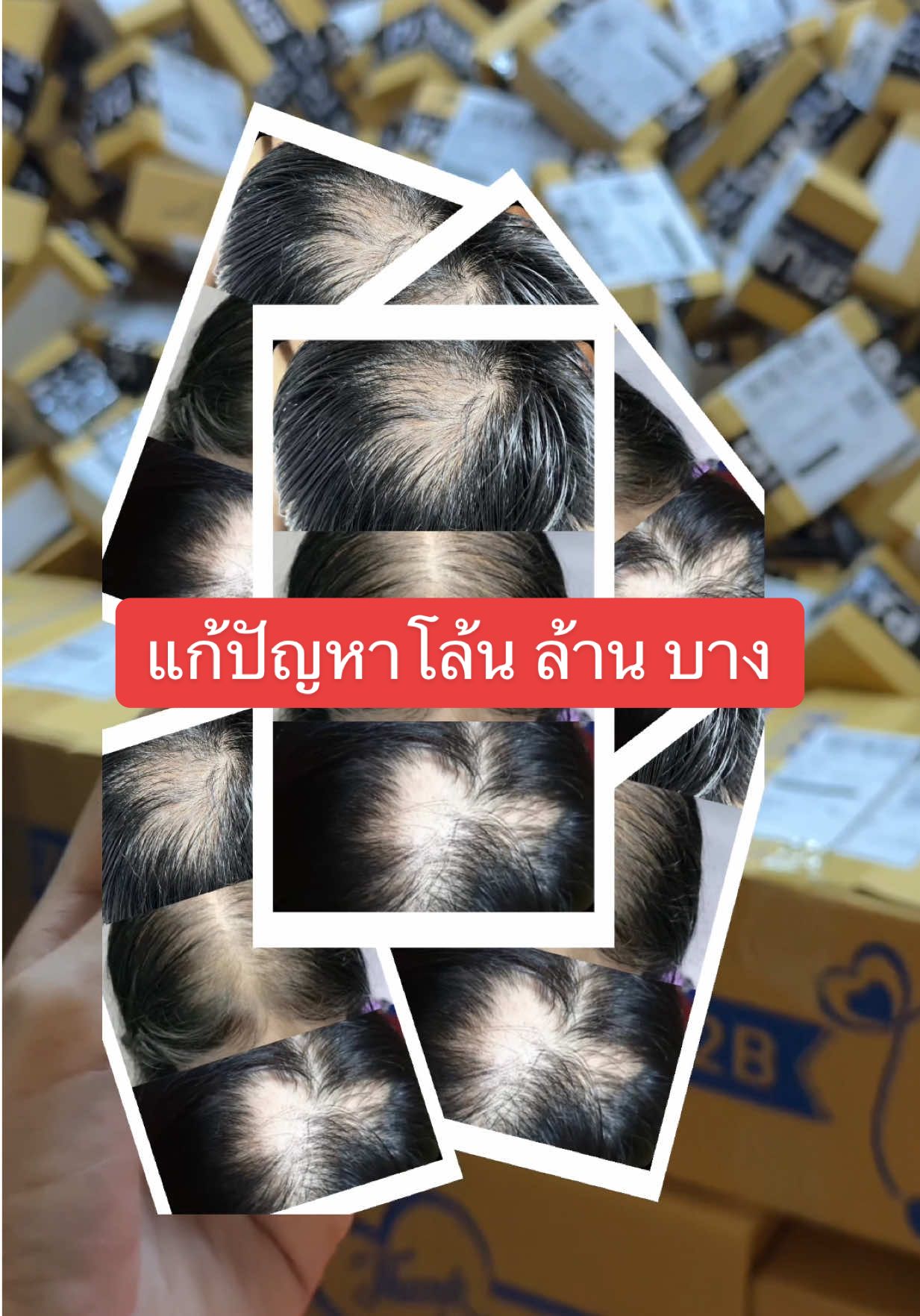 แก้ปัญหาได้ตรงจุดบอกลาความโล้นต้อง #PJSERUM #ผม #ปลูกผม #ผมบาง #ผมร่วง 