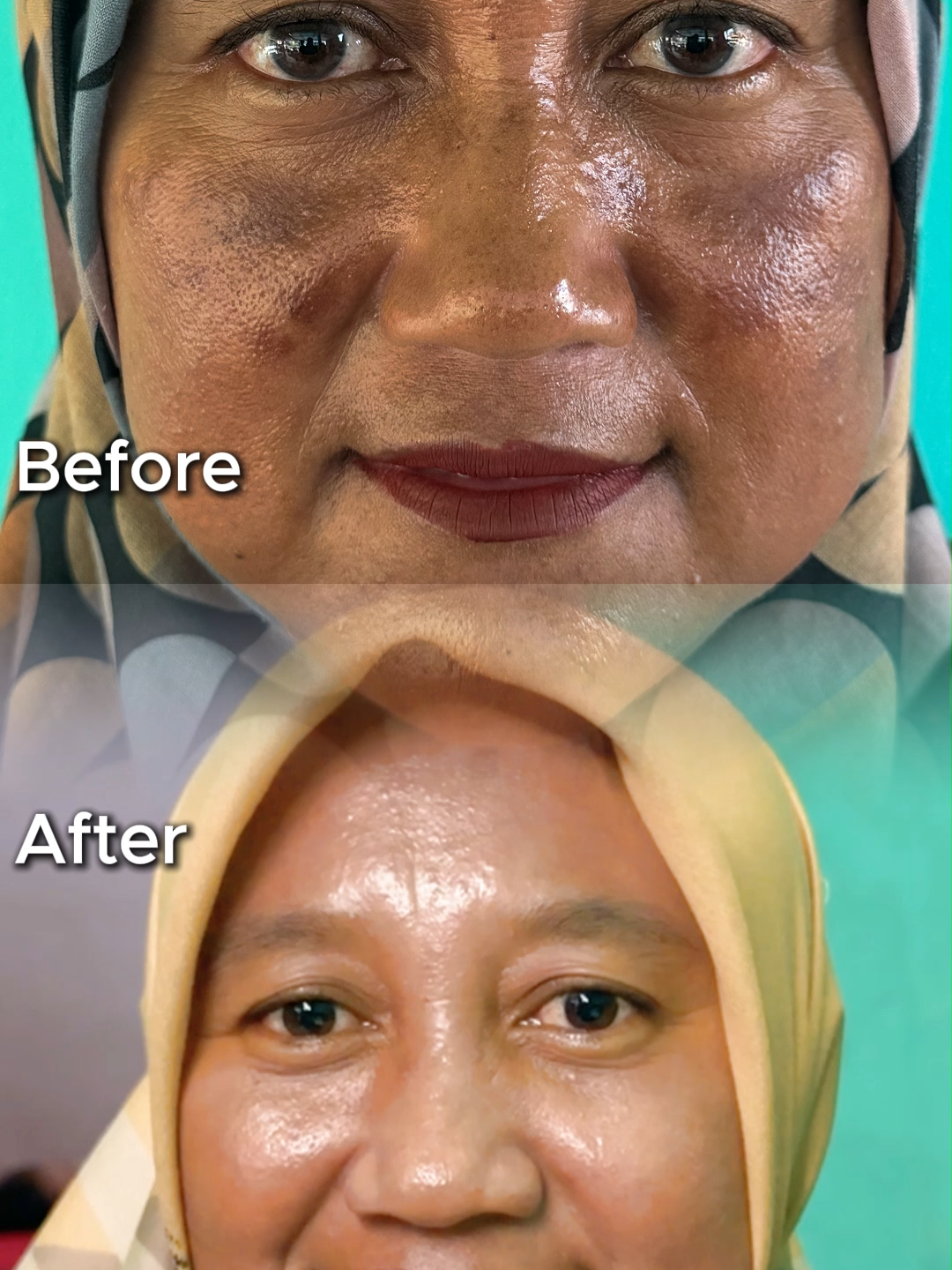 Kondisi kulit aku sebelum dan sesudah pakai kyura ✨ #fyp #kyura #kyuradarkspot #kyuradarkspotserum #darkspotserum