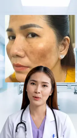 Nawala ang melasma pero gamitin ito? check the yellow basket! #fypage #foryoupage #fyp #trending #fyppppppppppppppppppp 