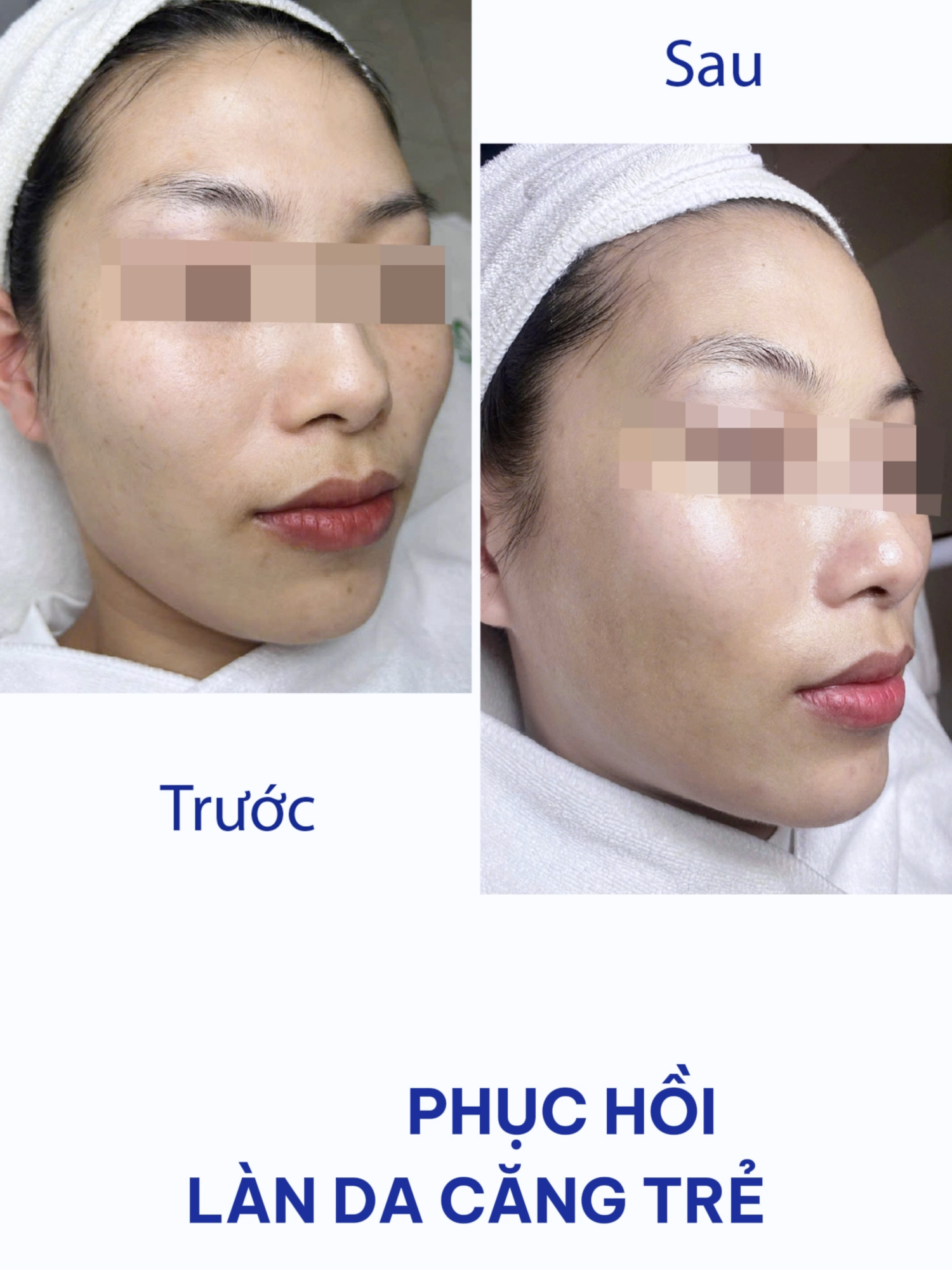 SẠCH NÁM ĐẾN 95% - CHỈ SAU 1 LIỆU TRÌNH Với phác đồ trị nám HYPER S+ tiên tiến, được FDA Hoa Kỳ chứng nhận, LAN Beauty tự hào là đơn vị uy tín về điều trị nám - tàn nhang.   Không bong tróc – Không xâm lấn – Không cần nghỉ dưỡng. 👉  Đặc biệt, ưu đãi tháng 10: Giảm 50% toàn bộ liệu trình nám  >>  Inbox ngay để được tư vấn miễn phí! #lanbeautycenter #dieutrinam #tannhang #spa