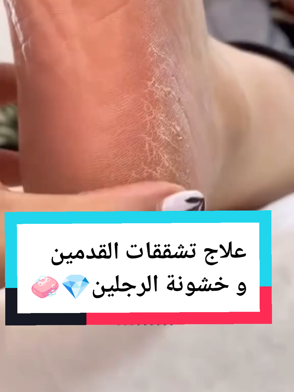 كنت استحي ابين رجلي من كثر التشققات 🤭 #foryou #اكسبلور #fyp #تشققات_القدمين #سكراب 
