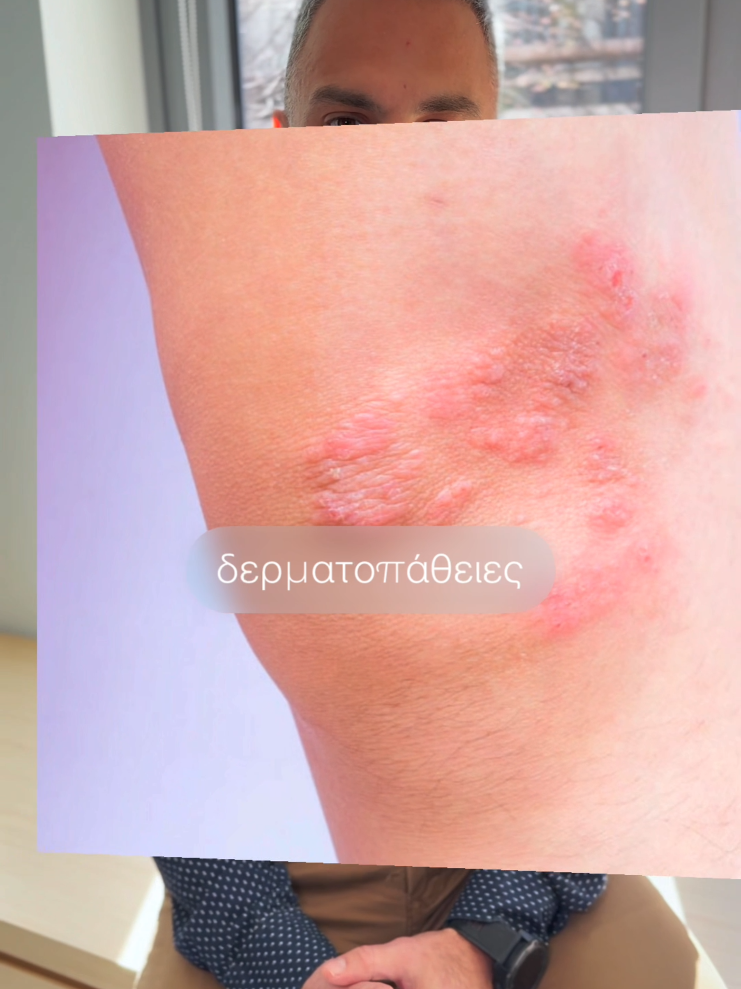 🧴 Ξηρό δέρμα που δεν λέει να ηρεμήσει; Η ατοπική δερματίτιδα είναι πιο συχνή απ’ όσο νομίζεις και η σωστή ενυδάτωση είναι το πρώτο βήμα για να την αντιμετωπίσεις. 🚿 Προτίμησε χλιαρό νερό, ήπιο καθαριστικό και μαλακτικά ρούχα στο δέρμα. Μικρές αλλαγές, μεγάλη διαφορά. 📲 Δες το βίντεο με τον Δερματολόγο Κωστή Σταματόπουλο και μάθε πώς μπορείς να βοηθήσεις το δέρμα σου να “ηρεμήσει”. #endoderma #tiktokdoc #dermatology #atopicdermatitis #skincare #dryskin #eczema #hydration #skinhealth #dermatologist #medicaltiktok #δερματολογία #ατοπικήδερματίτιδα #δέρμα #φροντίδαδέρματος #ενυδάτωση #υγείαδέρματος