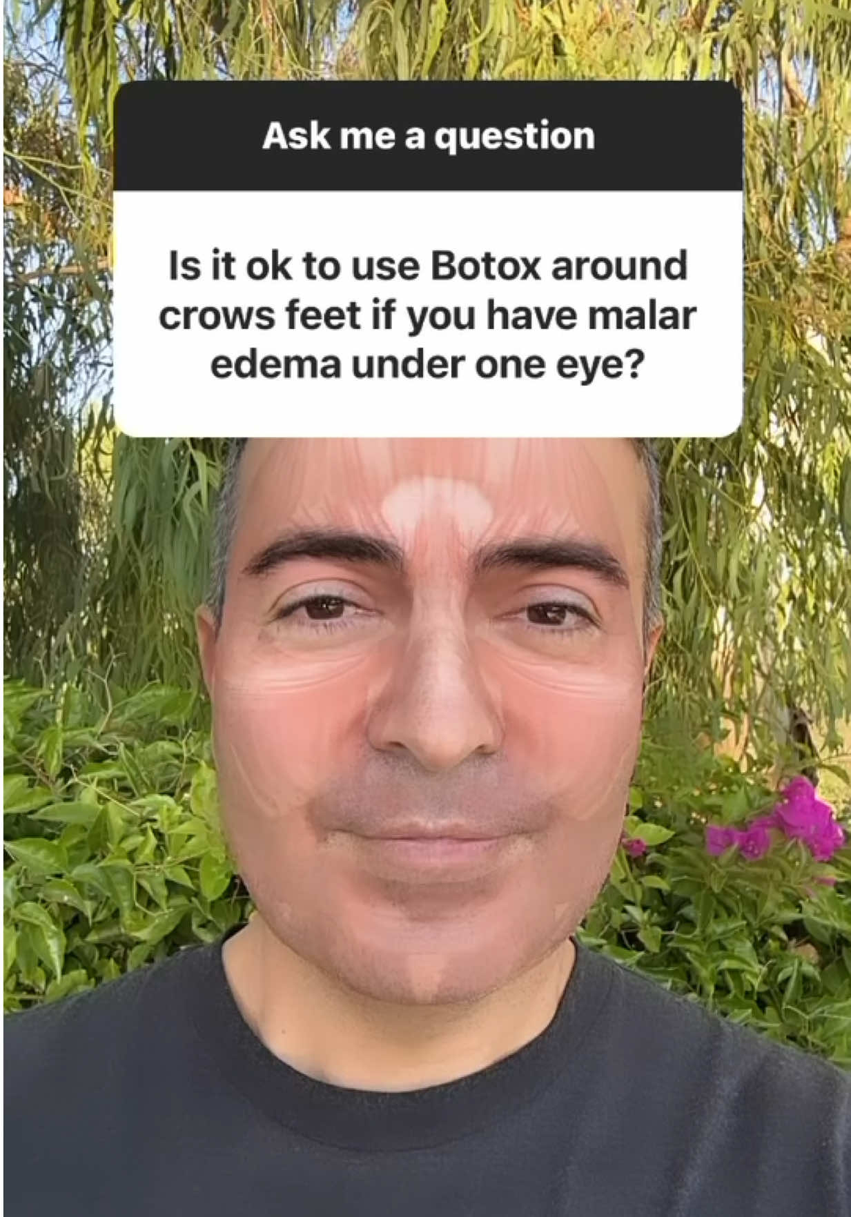 Can you Botox the crow’s feet area if you have malar edema? . . . #botox #crowsfeet #malaredema #kamiparsamd