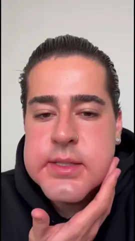 #ruyter #armonizacionfacial 