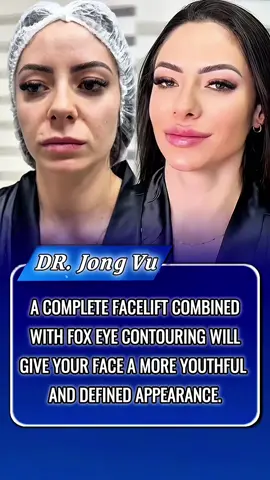 A complete facelift combined with fox eye contouring will give your face a more youthful and defined appearance. #fullfacelift #midfacelift #surgery #kualalumpur #drjong 